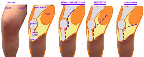 Tka Surgical Approach Hip Knee Book