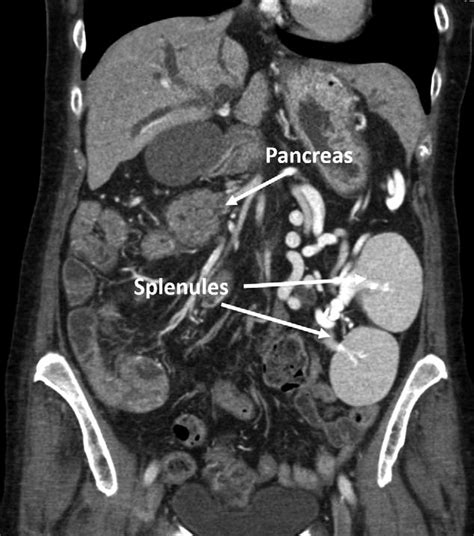 Pancreatic Mass Arrow And 2 Of The Splenules In The Left Side Of The