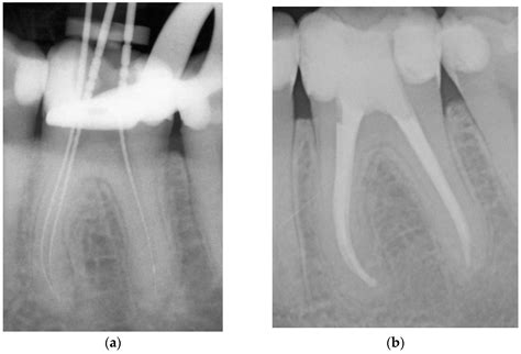 Dentistry Journal Free Full Text Endodontic Outcome Of Root Canal