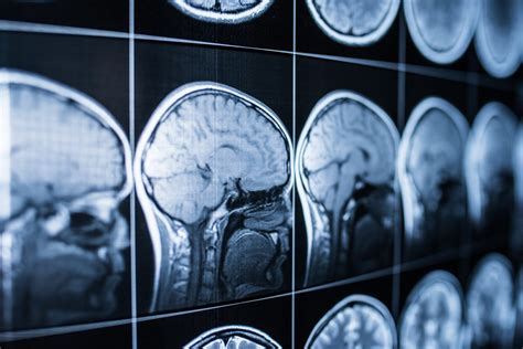 Qu Son Las Lesiones Cerebrales Traum Ticas Los Mejores Abogados De