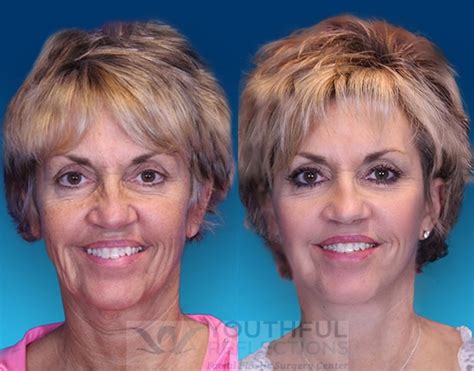 Laser Skin Resurfacing Before And After - 02/2022