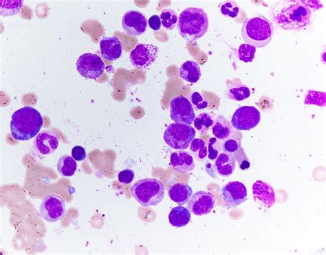 Pathology Outlines Chronic Neutrophilic Leukemia