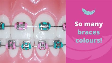 How To Choose Colours For Your Braces Gentle Touch Orthodontics