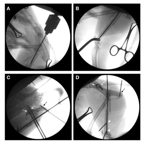 Intraoperative Fluoroscopic Series Showing Closed Reduction And