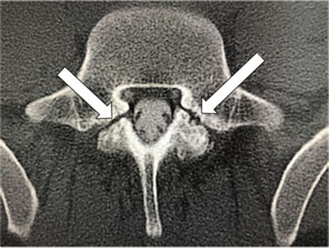 Computed Tomography Myelogram Axial View Demonstrated Bilateral L5