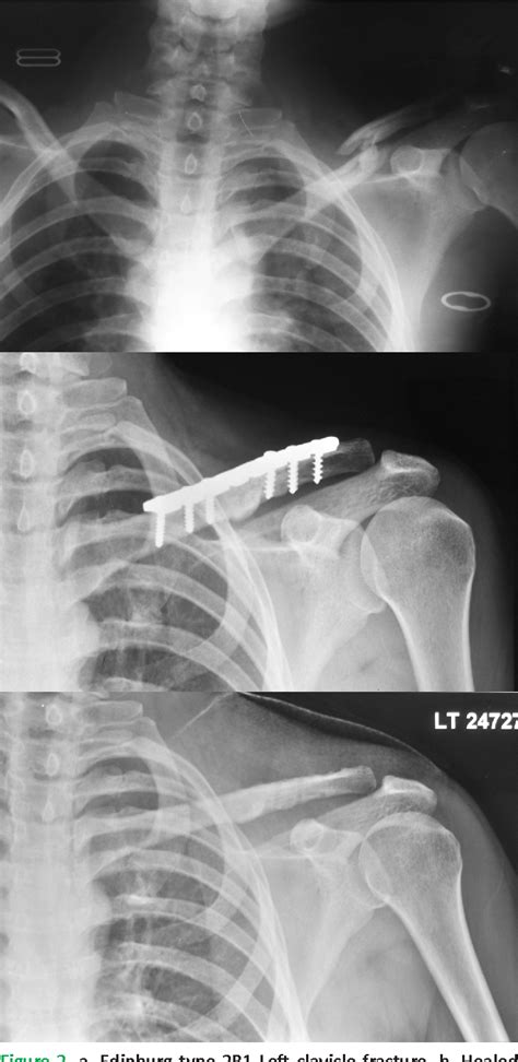 Operative Fixation Of Displaced Middle Third Clavicle Edinburg Type