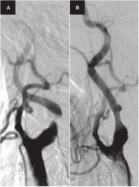 Right Common Carotid Angiography Before And After Cas A And B Download Scientific Diagram