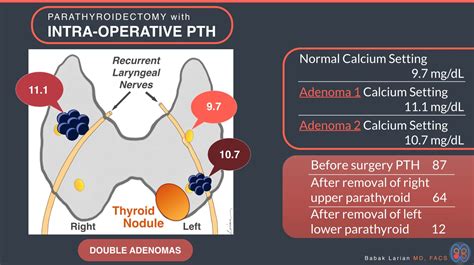 Parathyroidectomy With Intra Operative Pth Double Adenomas