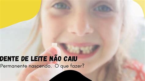 Dente Permanente Nascendo E De Leite N O Caiu O Que Fazer Youtube