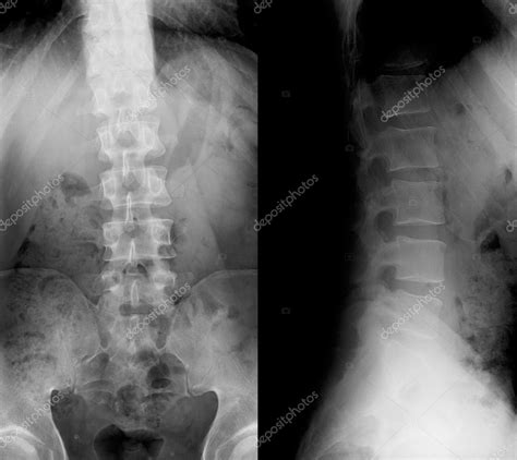 Sacrum Xray