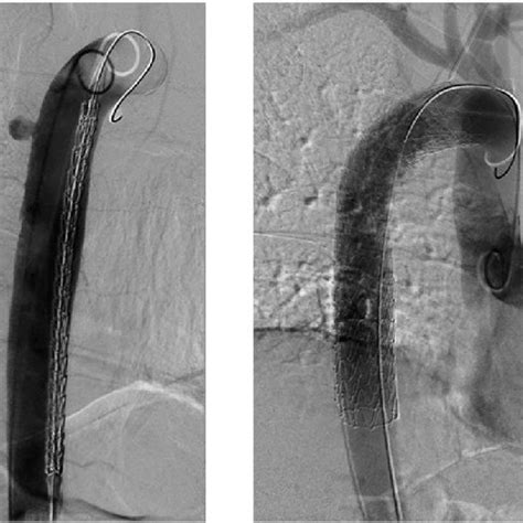 Cap Assisted Enteroscopy For Treatment Of Multiple Angioectasias Download Scientific Diagram