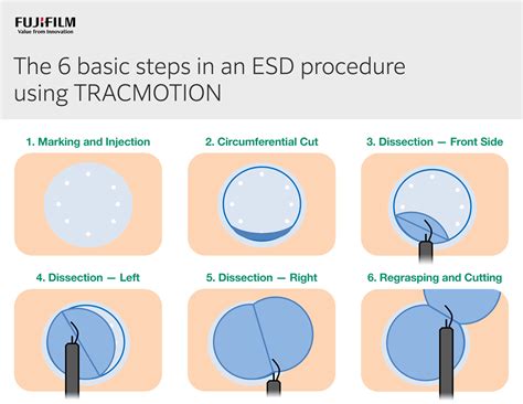 Esd Endoscopic Submucosal Dissection Clinical Learning And Innovation Center