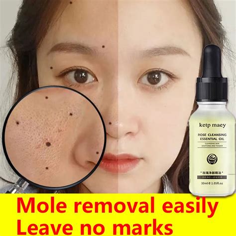 ?100% Effective Mole Remover Mole Removal Potion Mole Removal Cream ...