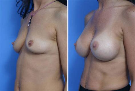 Breast Augmentation Case 8 Anthony Youn MD FACS