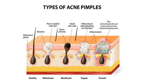 Acne Vs Zits Vs Pimples Whats The Difference Tiege Hanley