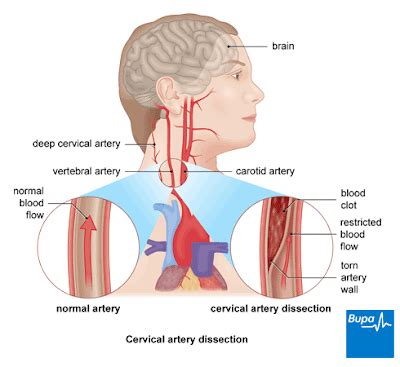 Carotid Artery Dissection - 3 Year Update | Carotid artery, Dissection ...