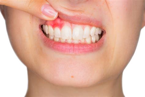 Gum Disease Treatment Dental Phobia