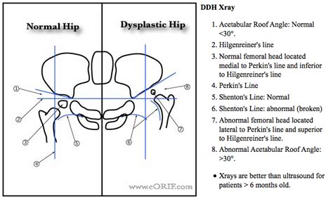 Developmental Dysplasia of the Hip | eORIF