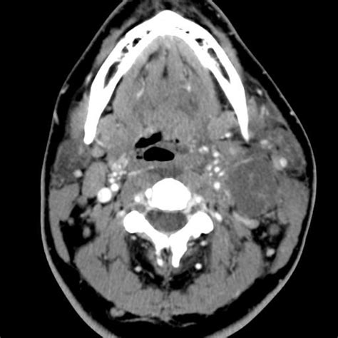 Second Branchial Cleft Cyst Neurorad911 Branchial Cyst