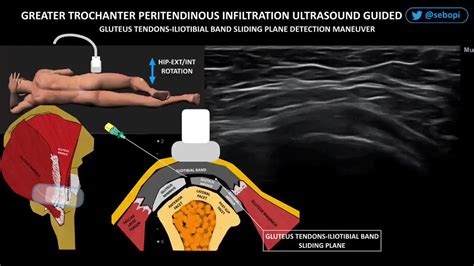 Iliotibial Band Ultrasound