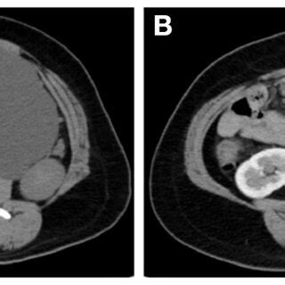 Ct Showed A Large Thin Walled Cystic Mass Of Low Density A With No