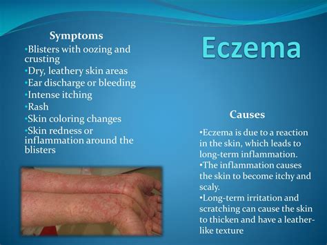 Ppt Eczema Powerpoint Presentation Free Download Id1995031