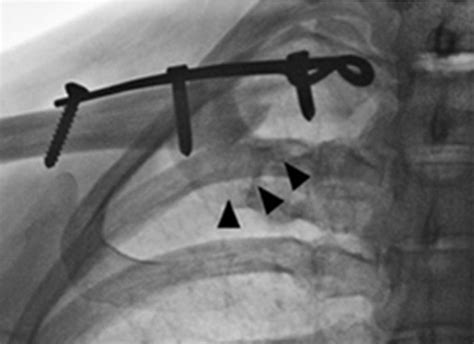 Estabilizaci N Esternoclavicular Dr Byron Torres Traumat Logo