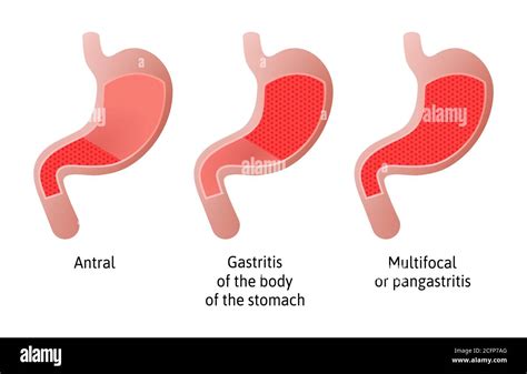 Inflamación Del Estómago Fotografías E Imágenes De Alta Resolución Alamy