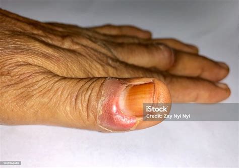 Paronychia At Thumb Of Asian Eldely Woman Stock Photo Download Image