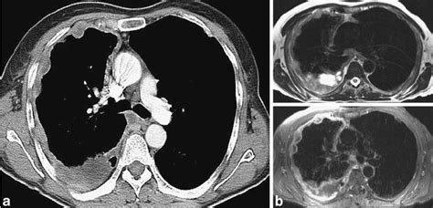 Example Of A Patient With Right Sided Mpm Malignant Pleural Download Scientific Diagram