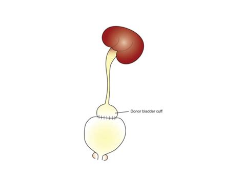 23: A cuff of the donor bladder anastomosed to the dome of the ...