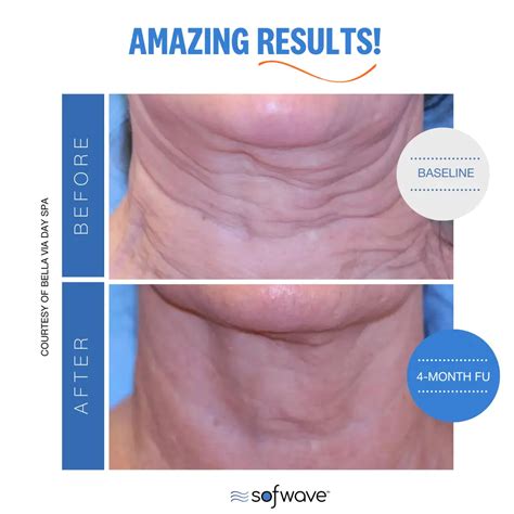 Sofwave™ Skin Tightening