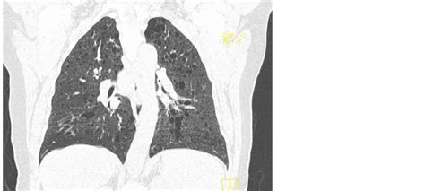 Pulmonary Lymphangioleiomyomatosis On A Post Menopausal Woman With