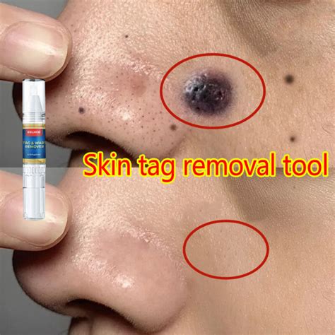 【eelhoe】skin Mole Removal Pen Wart And Skin Tag Remover Wart Remover Mole Removal Wart Removal