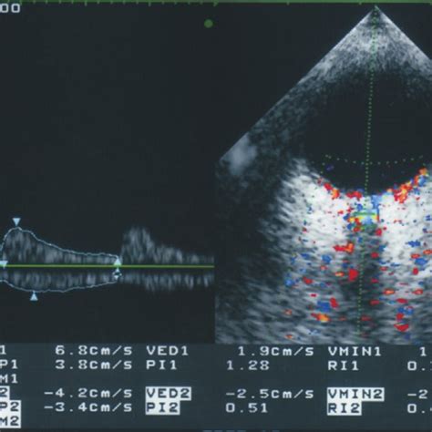 Color Doppler imaging of the CRA and CRV in the retrobulbar optic nerve... | Download Scientific ...