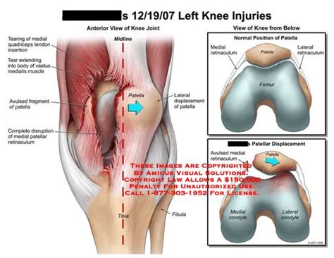 Amicus Illustration Of Amicus Injury Knee Tearing Medial Quadriceps