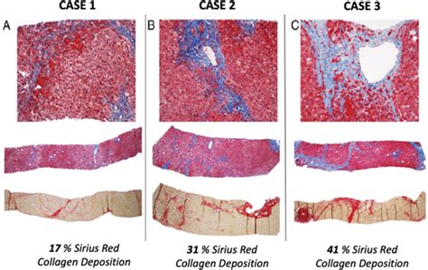 Liver Biopsy Samples With Sirius Red Staining For Quantification Of