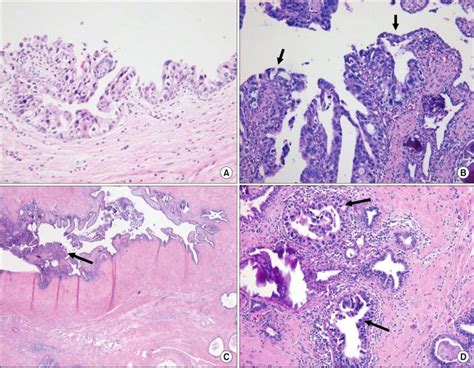 A Urothelial Carcinoma In Situ Is Observed In The Urinary Bladder Download Scientific