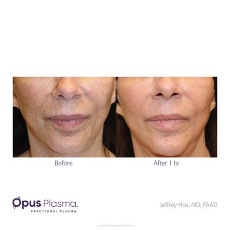 Opus Plasma Resurfacing In San Antonio Tx Westover Hills