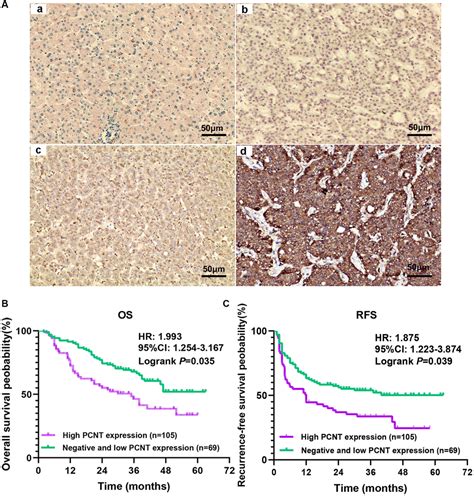 Pcnt Is A Prognostic Biomarker Correlated With Tumor Immune