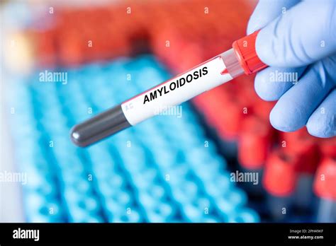 Amyloidosis Amyloidosis Disease Blood Test In Doctor Hand Stock Photo