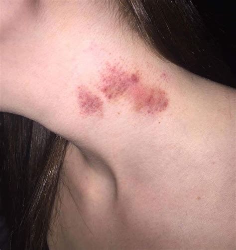 The Truth On Hickeys