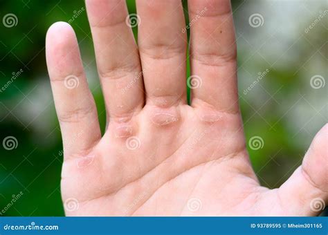 Hand With Callus Stock Image Image Of Finger Open Callused 93789595