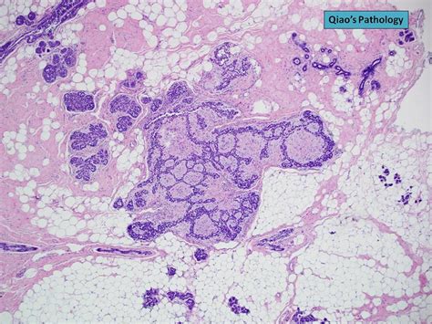 Qiao S Pathology Lobular Neoplasia Alh Lcis With Pagetoid Growth In