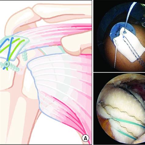 A Schematic Illustration Of Arthroscopic Rotator Cuff Repair With