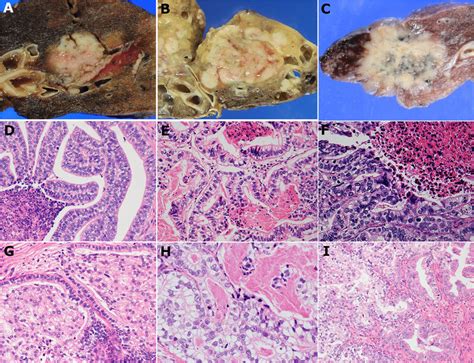 Representative Pathological Findings Of Pure Type Low And High Grade Download Scientific