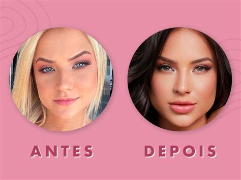 Preenchimento Labial Como Funciona E Valores Dream Plastic