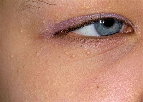 White Bump On Eyelid Causes Treatment Remedies Pictures