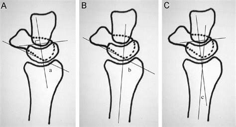 The Clinical Significance Of The Scaphoid Cortical Ring Sign A Study