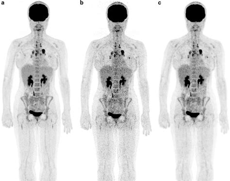 ¹⁸F FDG PET scan of a 29 year old woman with Hodgkin lymphoma and